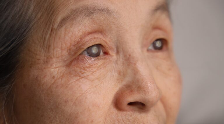 Eyes,Of,An,Elderly,Woman,With,Cataract,Disease,_close,Up